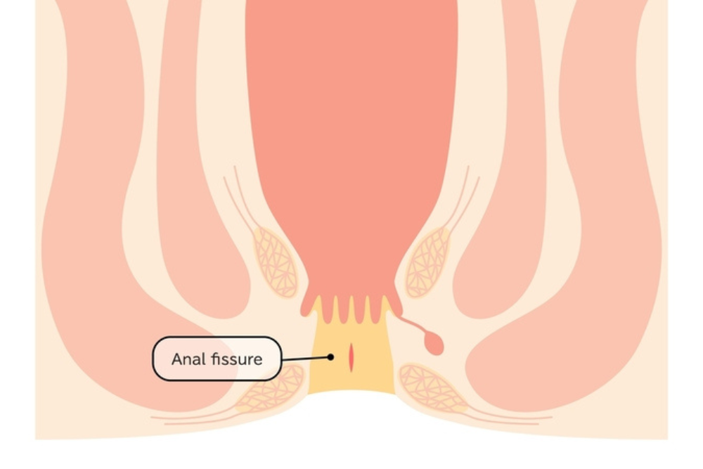 Ραγάδα δακτυλίου